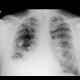 Malposition of portcatheter: X-ray - Plain radiograph